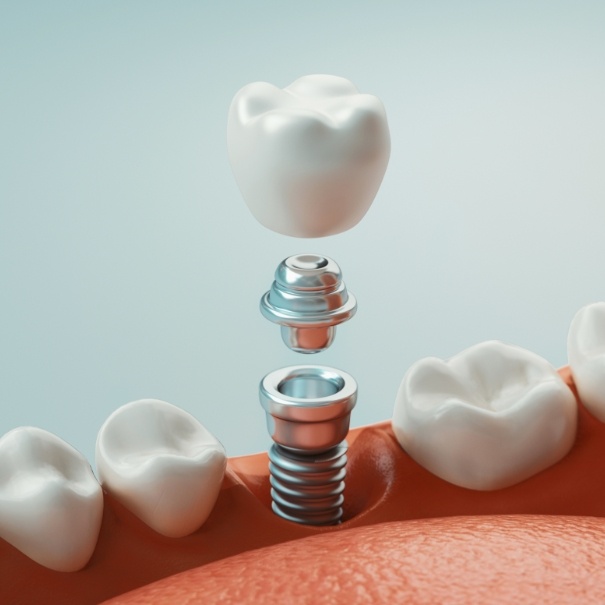 Animated dental implant placement
