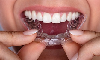 Closeup of patient placing clear aligners on top teeth