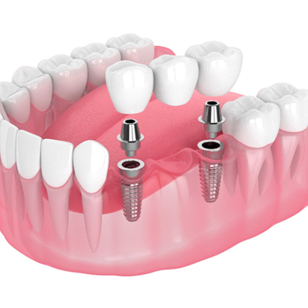 Diagram of an implant bridge in Bakersfield