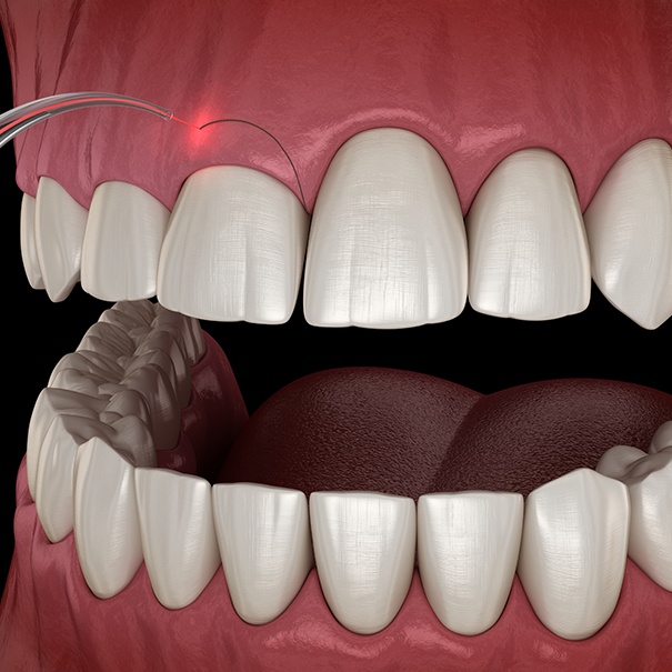 Animated smile during gum recontouring treatment