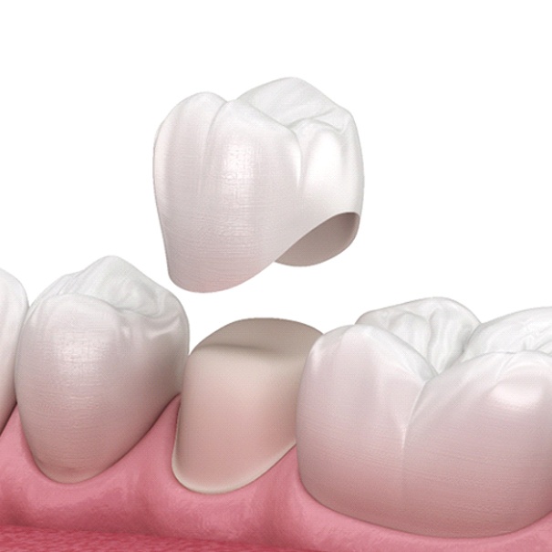 illustration of dental crowns process in Bakersfield