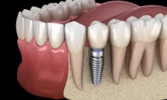 Animated dental implant supported dental crown placement