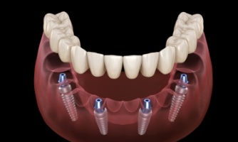 Animated dental implant supported denture placement