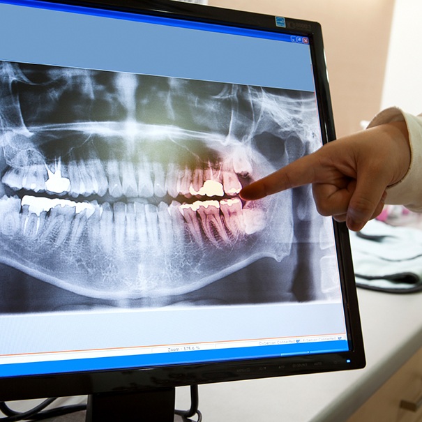 Digital x-rays on chairside computer monitor