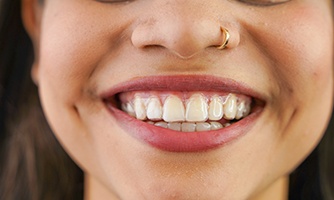 Invisalign aligners offer improved comfort over traditional braces