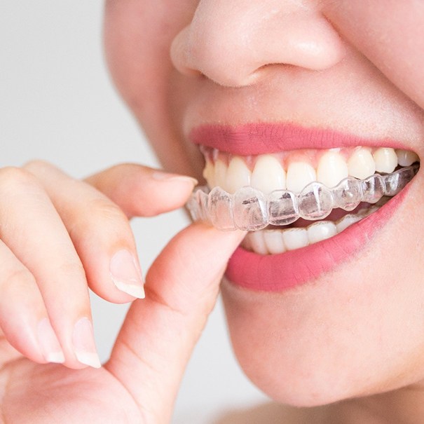 person putting Invisalign trays in their mouth
