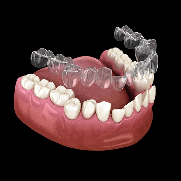Animated smile during Invisalign placement