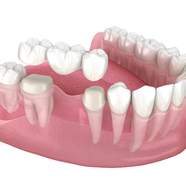 Diagram showing how dental bridges in Bakersfield work