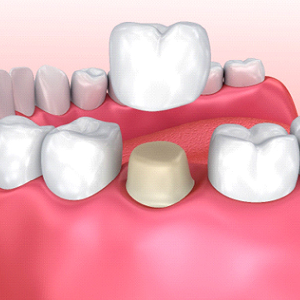 Diagram showing how dental crowns in Bakersfield work