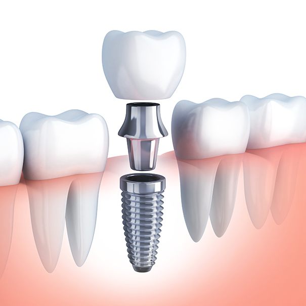 Animated dental implant supported dental crown placement