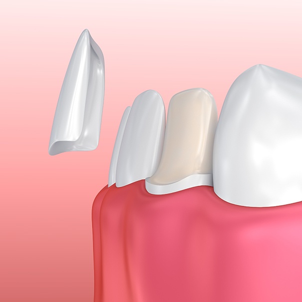 Animated smile during porcelain veneer placement