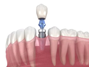 Digital model of a dental implant