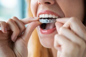 Woman fitting Invisalign aligner onto teeth.
